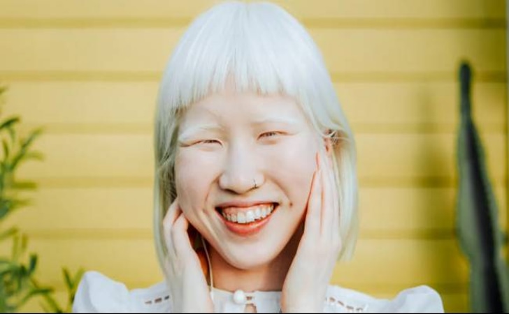 Albino.jpg