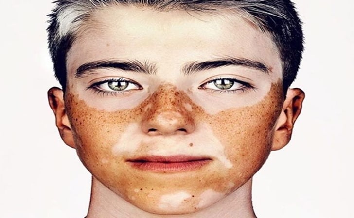 Vitiligo.jpg