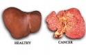 Perbandingan-Hati-Sehat-dan-Idap-Kanker.jpg